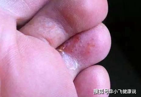 脚上红痒起皮，是脚气还是湿疹？一篇文章教你准确分辨